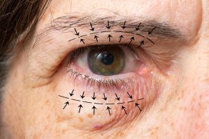 naitrika ocuplasty